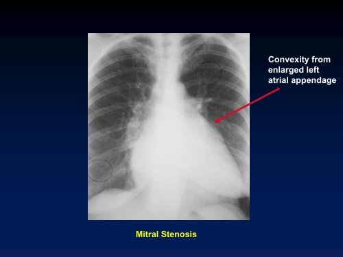 Valvular Lesions of the Heart - LearningRadiology