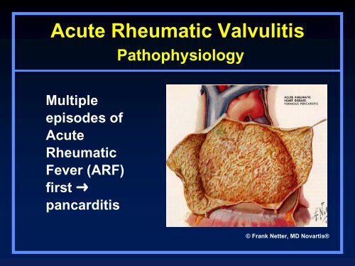 Valvular Lesions of the Heart - LearningRadiology