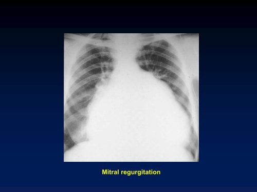 Valvular Lesions of the Heart - LearningRadiology