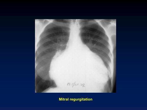 Valvular Lesions of the Heart - LearningRadiology