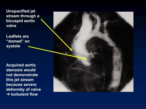 Valvular Lesions of the Heart - LearningRadiology