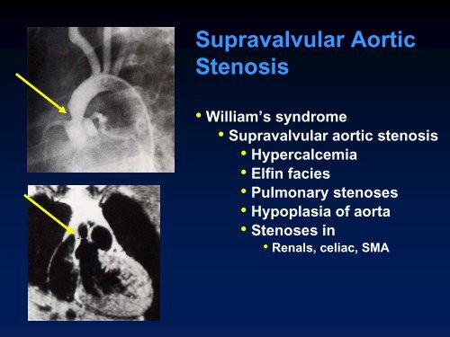 Valvular Lesions of the Heart - LearningRadiology