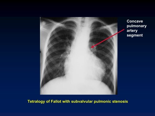 Valvular Lesions of the Heart - LearningRadiology