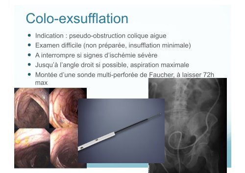 Traitement endoscopique des occlusions intestinales ... - Hepato Web