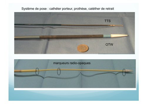 Traitement endoscopique des occlusions intestinales ... - Hepato Web