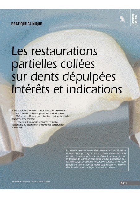 Les restaurations partielles collées sur dents dépulpées Intérêts et ...