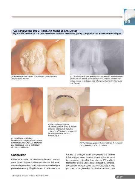 Les restaurations partielles collées sur dents dépulpées Intérêts et ...