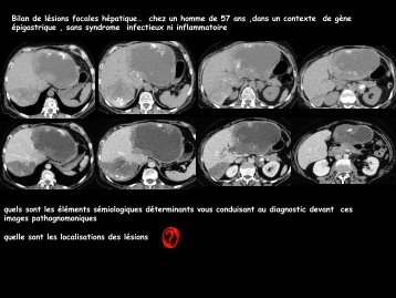 LM CC dig échinococcose alvéolaire - RADIOLOGIE BRABOIS