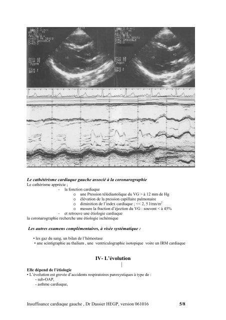 L’INSUFFISANCE CARDIAQUE GAUCHE