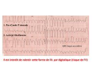 FA (QRS larges et variable) WPW