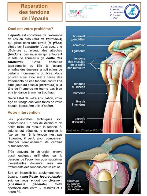 Réparation des tendons de l'épaule - ICOS 13