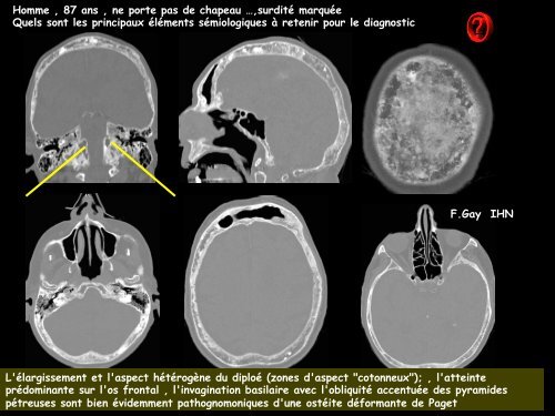 LM CC ostéo-artic osteitis deformans de Paget - RADIOLOGIE ...