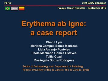 Erythema ab igne: a case report - Dermato.med