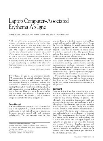 Laptop Computer–Associated Erythema Ab Igne - Cardiology News