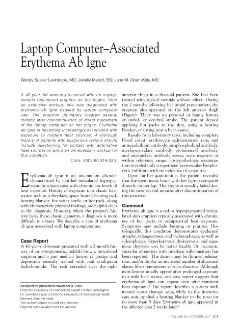 Laptop Computer–Associated Erythema Ab Igne - Cardiology News