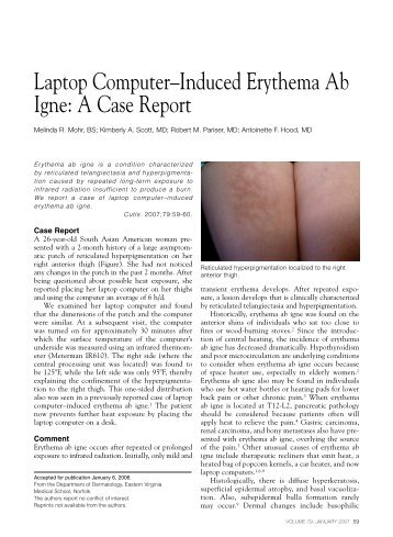 Laptop Computer–Induced Erythema Ab Igne - Skin & Allergy News