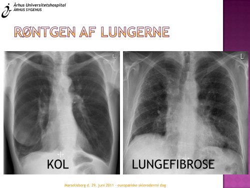 Når man fejler noget i lungerne