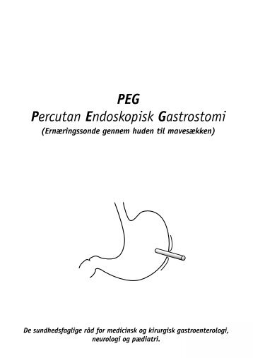 PEG Percutan Endoskopisk Gastrostomi - e-Dok