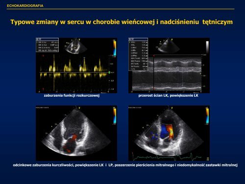 Echokardiografia w kardiologii