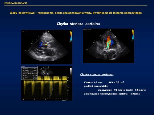 Echokardiografia w kardiologii