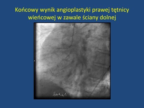 Rekanalizacja prawej tętnicy wieńcowej