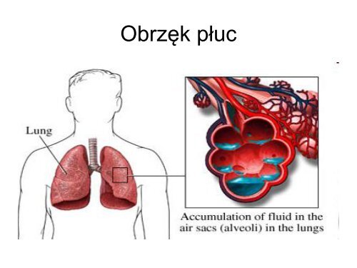 Ostra niewydolność serca