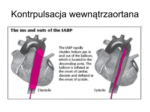 Ostra niewydolność serca