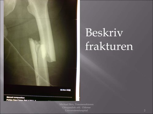 Frakturklassifikation, erfaring med systematisk klassifikation, dansk ...