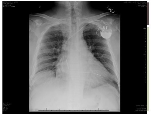 Splenic Infarct, Atrial Fibrillation