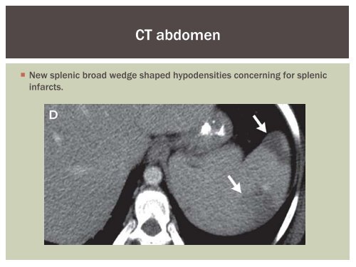 Splenic Infarct, Atrial Fibrillation