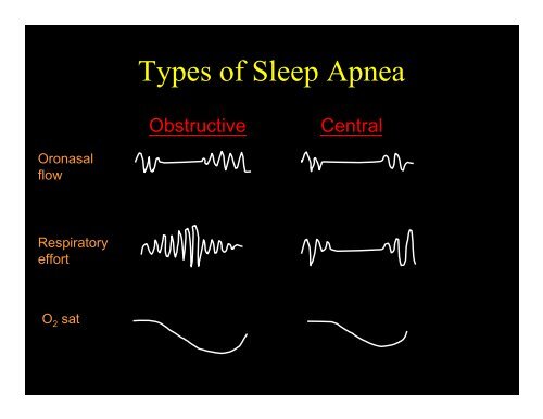 Obstructive Sleep Apnea