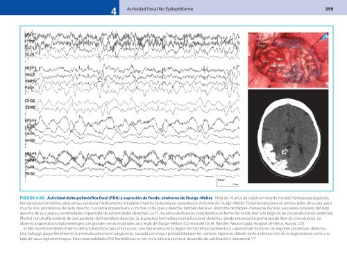 Actividad Focal No Epileptiforme 359 - Axon