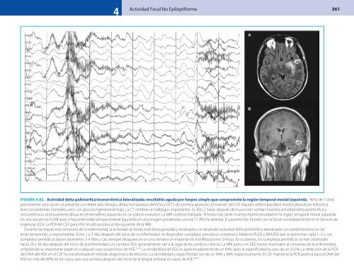 Actividad Focal No Epileptiforme 359 - Axon