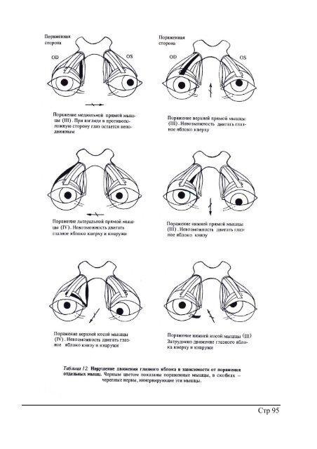 Заболевания косоглазие. Ограничение движения глазного яблока. Глазодвигательные мышцы глаза иннервация. Птоз верхнего века парез глазодвигательного нерва. Паралитическое косоглазиеие.