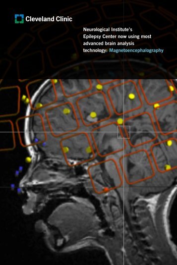 Neurological Institute's Epilepsy Center now ... - Cleveland Clinic