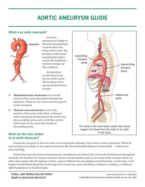 Aortic Aneurysm Guide - Cleveland Clinic