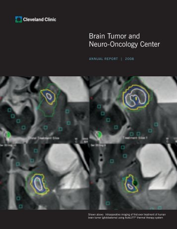 Brain Tumor and Neuro-Oncology Center - Cleveland Clinic