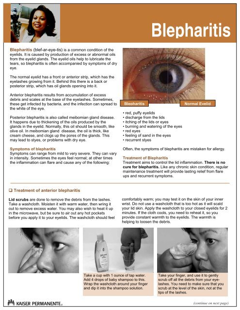 Blepharitis Branded V4 2010