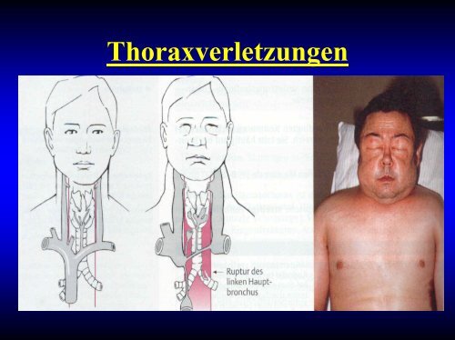 Thoraxprellung (Commotio thoracis)