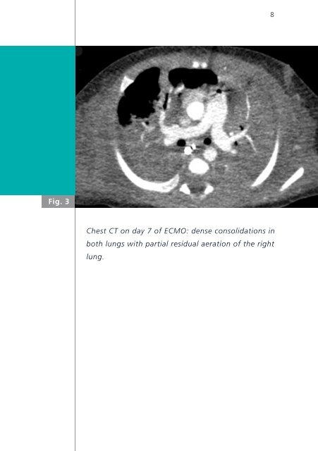 Fatal pertussis infection - Swiss Society of Neonatology