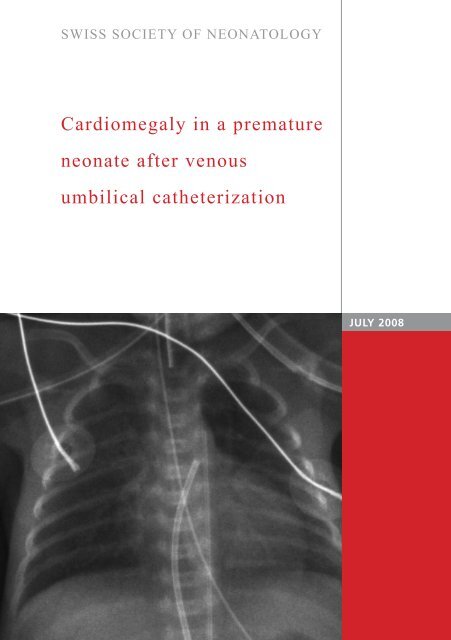 Cardiomegaly in a premature neonate after venous umbilical ...