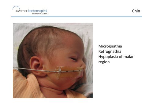 Clinical approach to the dysmorphic neonate