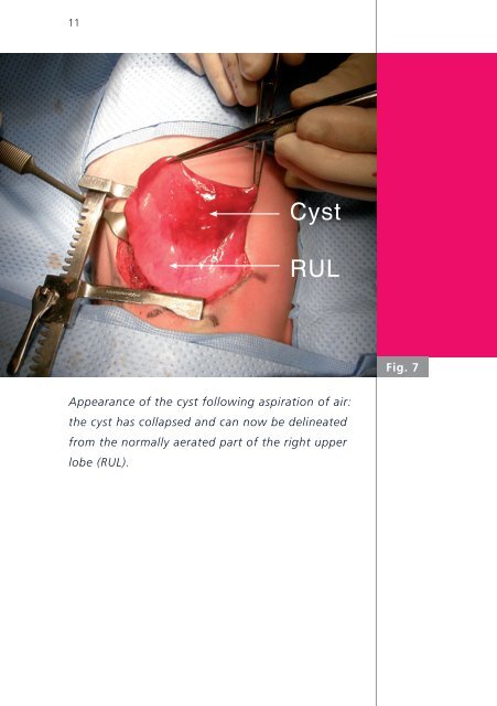 Perinatal management of a large bronchogenic cyst - Swiss Society ...