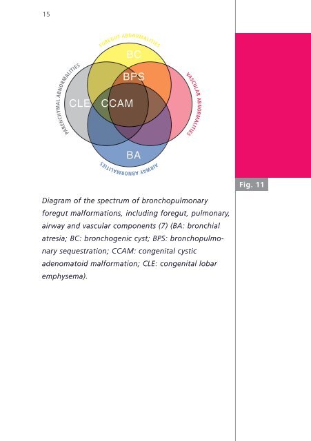 Perinatal management of a large bronchogenic cyst - Swiss Society ...