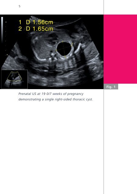 Perinatal management of a large bronchogenic cyst - Swiss Society ...