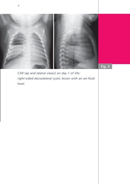 Perinatal management of a large bronchogenic cyst - Swiss Society ...