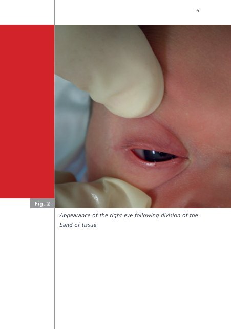 Ankyloblepharon filiforme adnatum - Swiss Society of Neonatology