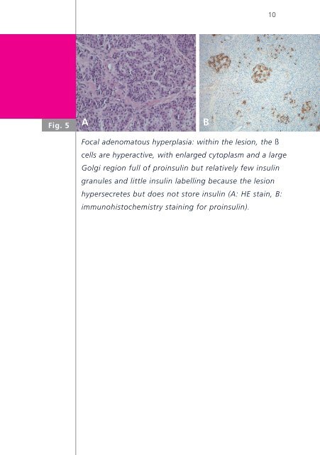 Congenital hyperinsulinism - Swiss Society of Neonatology