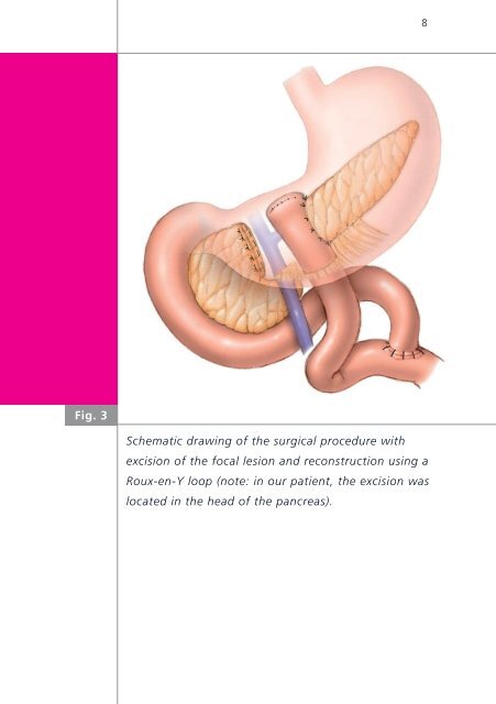 Congenital hyperinsulinism - Swiss Society of Neonatology