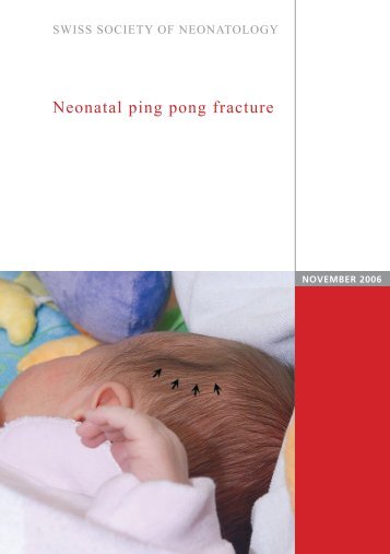 Neonatal ping pong fracture - Swiss Society of Neonatology